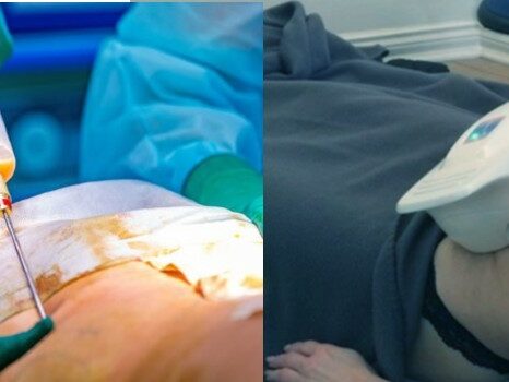 Fedtsugning versus fedtfrysning